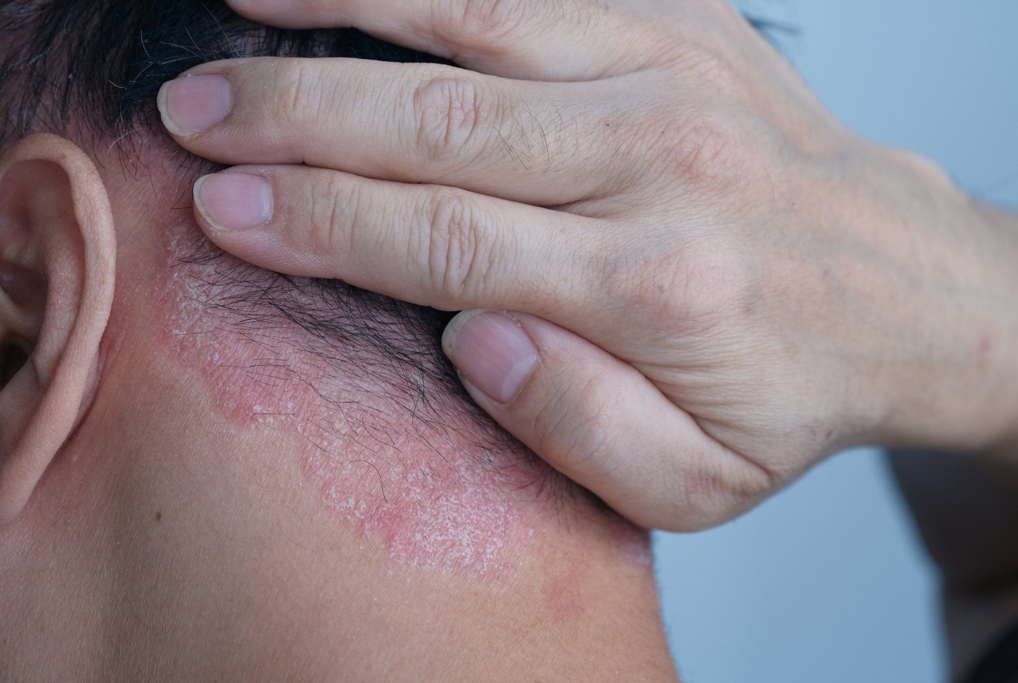 Mand med psoriasis i hovedbunden